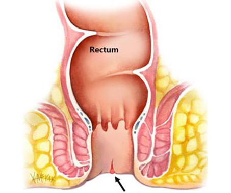 Anal Fissure