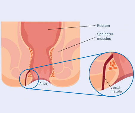 Anal Fistula