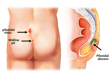 Pilonidal Sinus