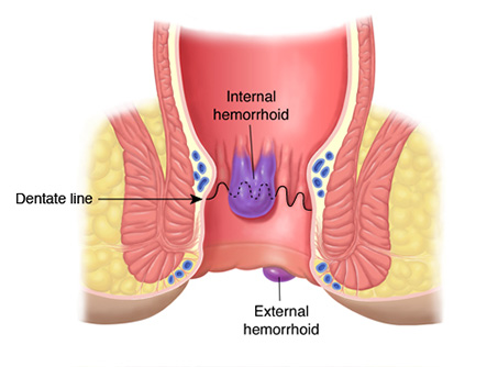 Internal and External Hemorrhoids
